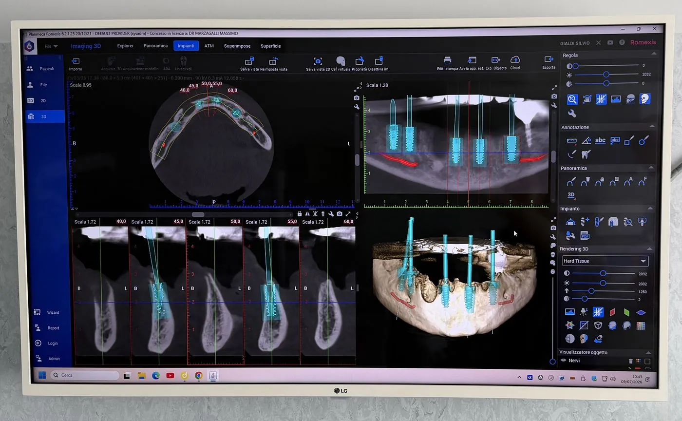 TAC 3D (Cone Beam - CBCT)